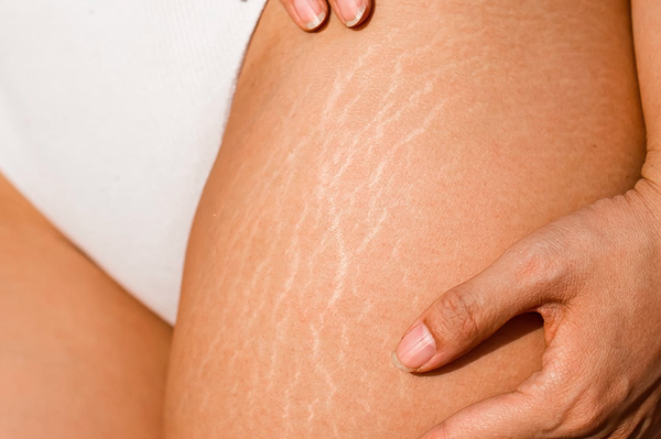 Stretch marks