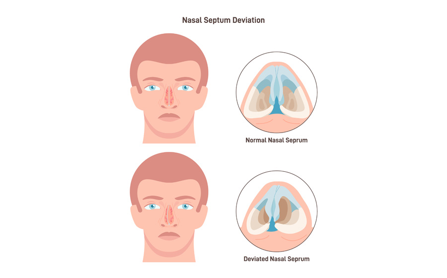 Do you have sleep disturbance due to deviated nasal septum?